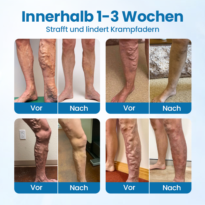 Glowrizon® VeinGuard Herbal Spray – Clinically Proven to Diminish Varicose Veins in Just 7 Days