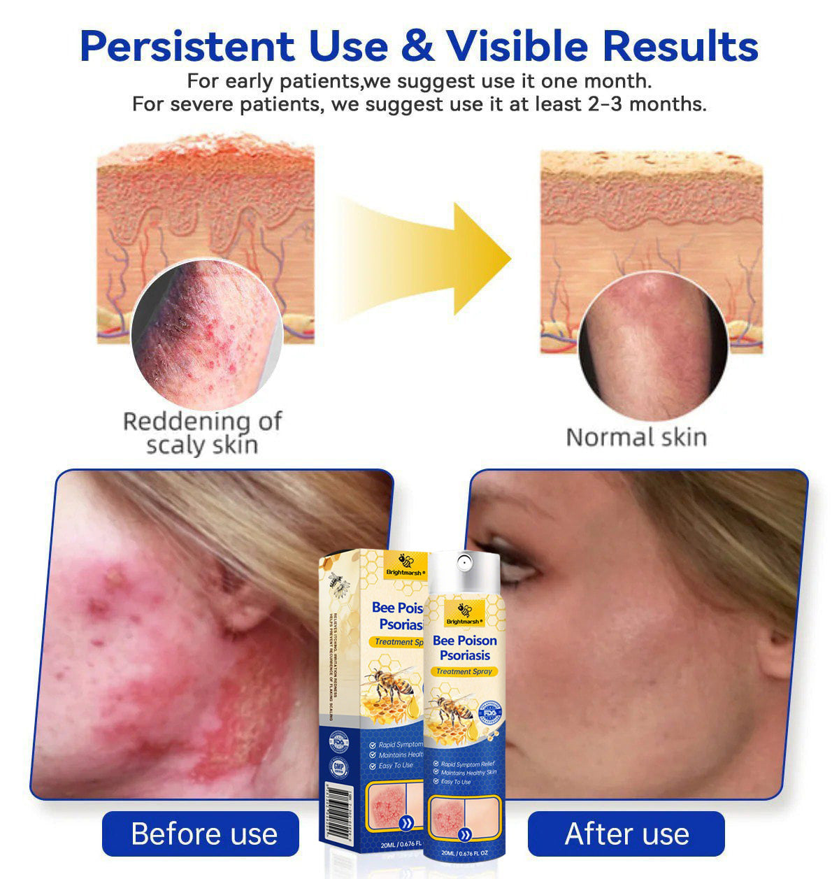 ⭐ Brightmarsh® Bee Poison Psoriasis Treatment Spray 🐝 LIMITED OFFER 60% OFF 💛