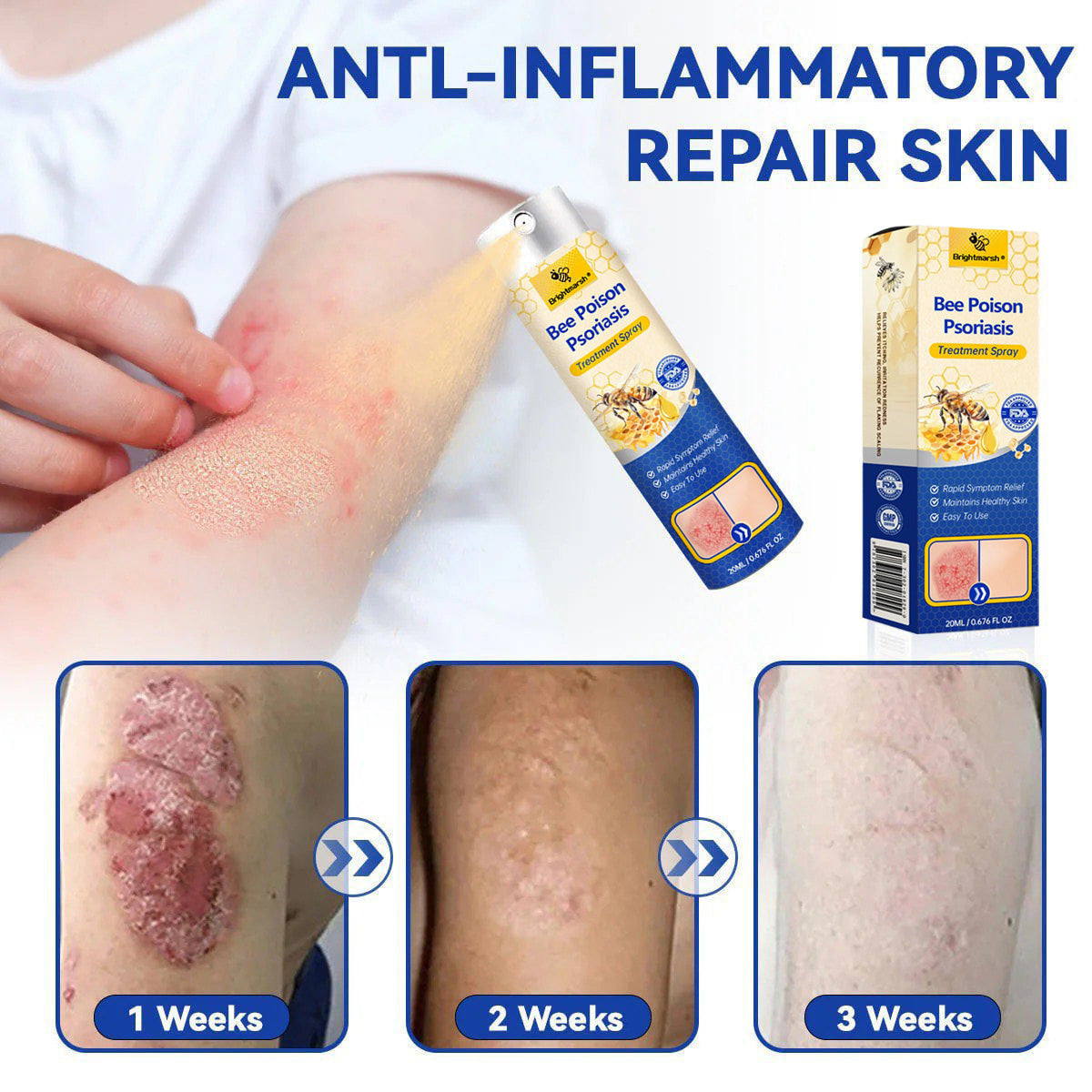 ⭐ Brightmarsh® Bee Poison Psoriasis Treatment Spray 🐝 LIMITED OFFER 60% OFF 💛