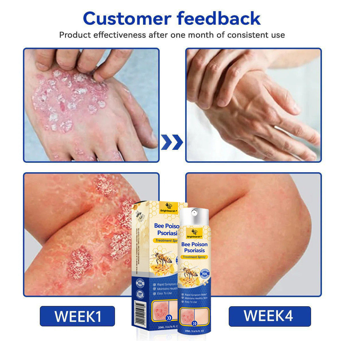 ⭐ Brightmarsh® Bee Poison Psoriasis Treatment Spray 🐝 LIMITED OFFER 60% OFF 💛
