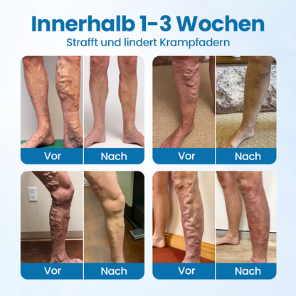 Glowrizon® VeinGuard Herbal Spray – Clinically Proven to Diminish Varicose Veins in Just 7 Days