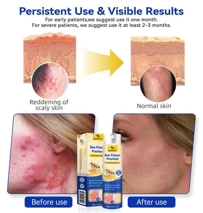 ⭐ Brightmarsh® Bee Poison Psoriasis Treatment Spray 🐝 LIMITED OFFER 60% OFF 💛